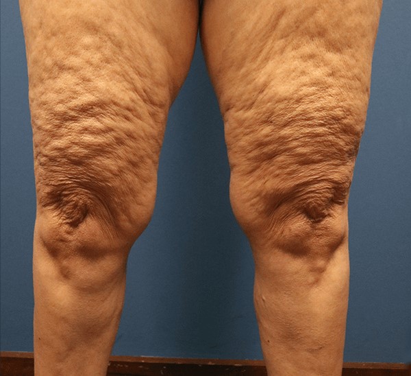 CELLULITE REDUCTION OIL